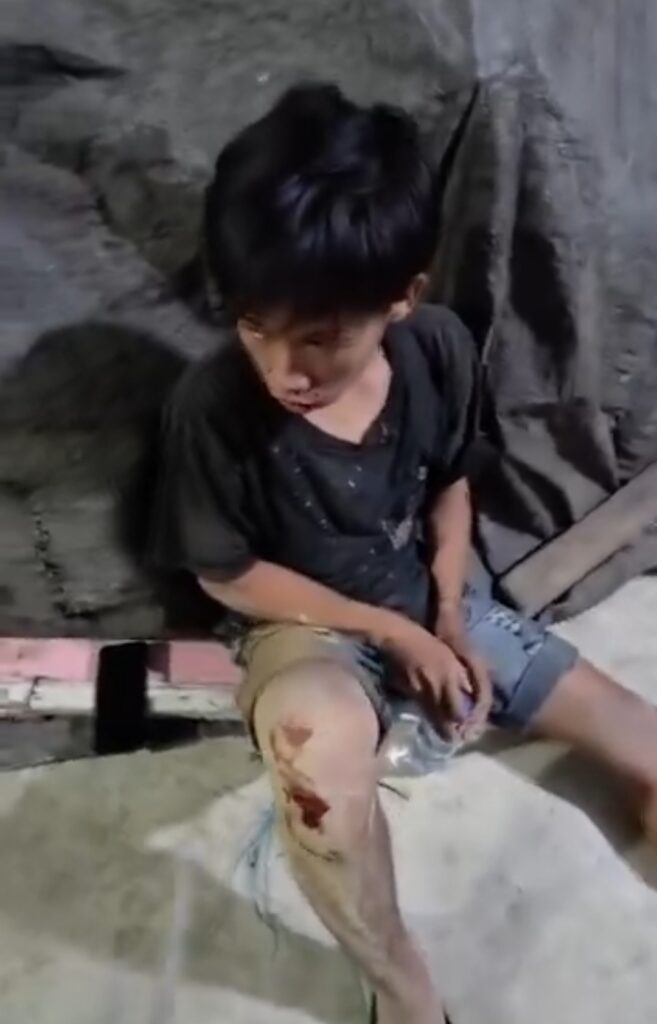 Salah satu korban begal di Sekatak alami luka- luka di bagian kaki